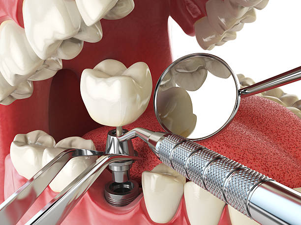 Best Chipped Tooth Repair Near Me  in Avodo Heights, CA
